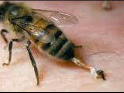 Что делать если укусила оса или пчела