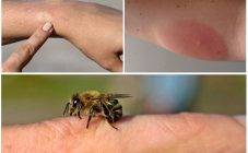 Может ли укус осы вызвать аллергическую реакцию?