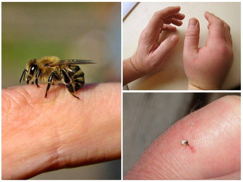 Укус пчелы: польза или вред