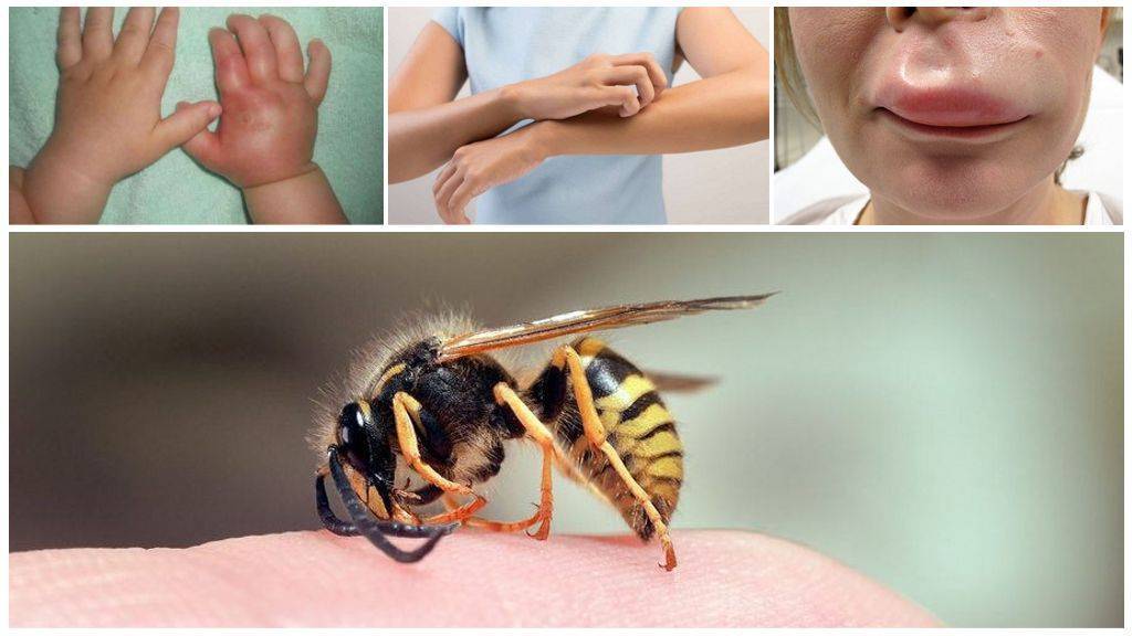 Что делать в домашних условиях если укусила пчела, первая помощь, как снять отек