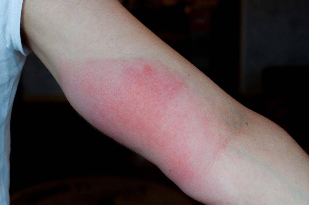 Аллергия на укусы насекомых (видео)