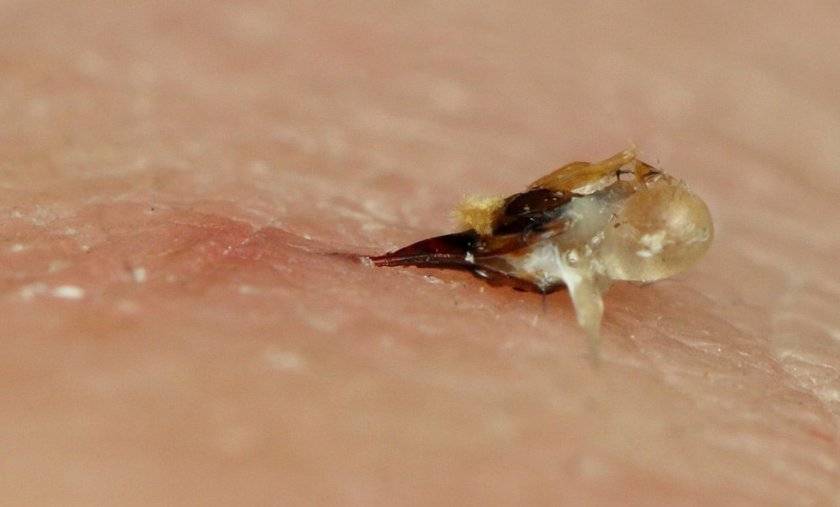 Оказание помощи при укусе осы