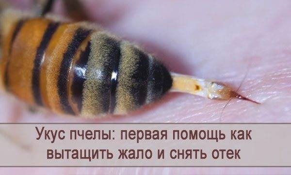 Что делать, если укусила пчела, как снять отек и покраснение?