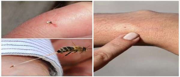 Аллергическая реакция на укус пчелы — первая помощь — вода — источник красоты и молодости