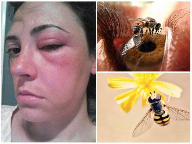 Укус пчелы: опухоль, покраснение, что делать, как снять отек?